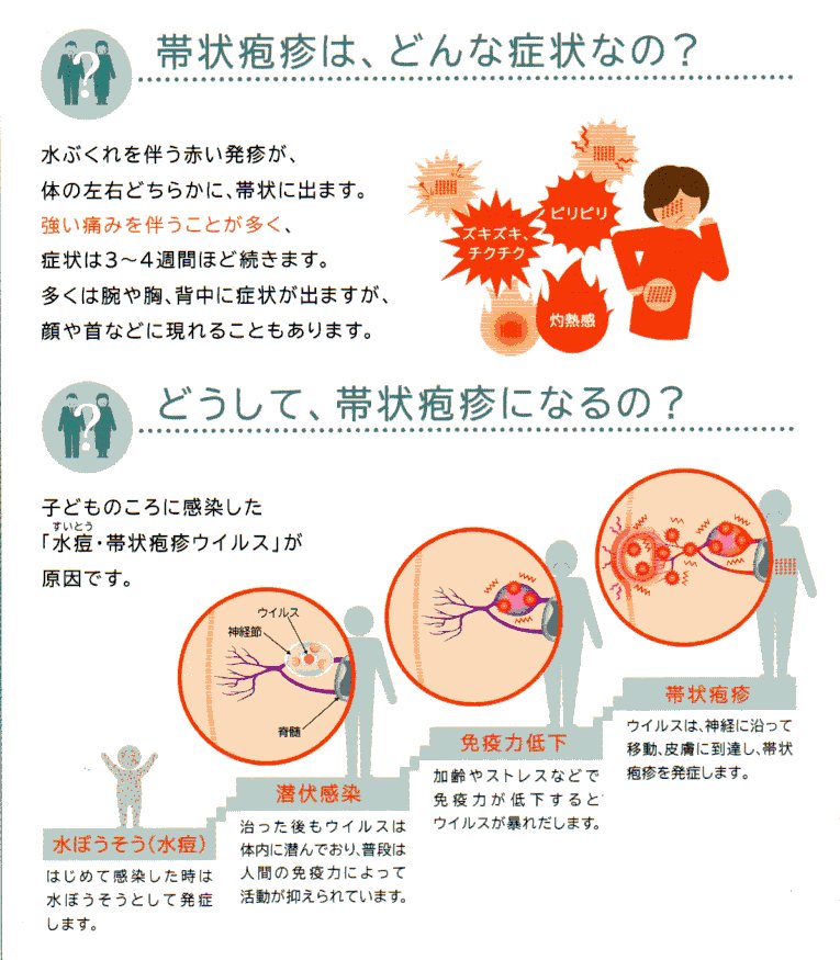 帯状疱疹1